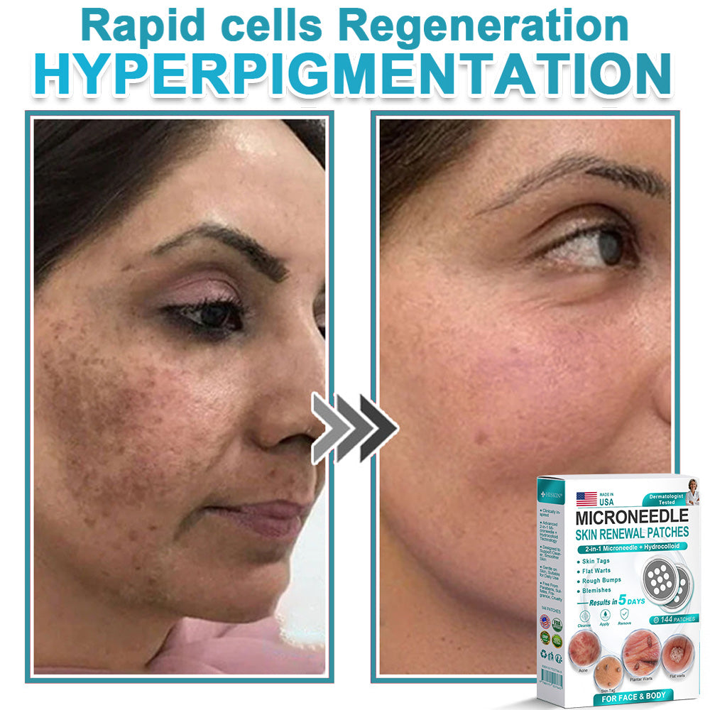 AIYNS Official Store -  2-in-1 Microneedle & Hydrocolloid Patch👨‍⚕️ | Removes raised moles, acne, flat warts, and skin tags | Helps improve wrinkles, scars, and blemishes | Invisible patches for face and body
