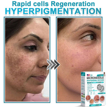 AIYNS Official Store -  2-in-1 Microneedle & Hydrocolloid Patch👨‍⚕️ | Removes raised moles, acne, flat warts, and skin tags | Helps improve wrinkles, scars, and blemishes | Invisible patches for face and body