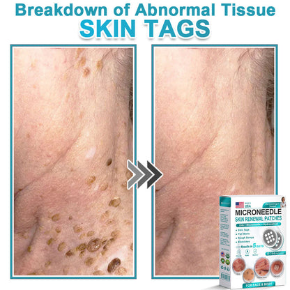 AIYNS Official Store -  2-in-1 Microneedle & Hydrocolloid Patch👨‍⚕️ | Removes raised moles, acne, flat warts, and skin tags | Helps improve wrinkles, scars, and blemishes | Invisible patches for face and body