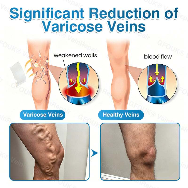 🇺🇸🏅🌱AIYNS Official Store -  VeinRepair Microneedle Patch Roll⚡Instant Relief, Long-Term Results