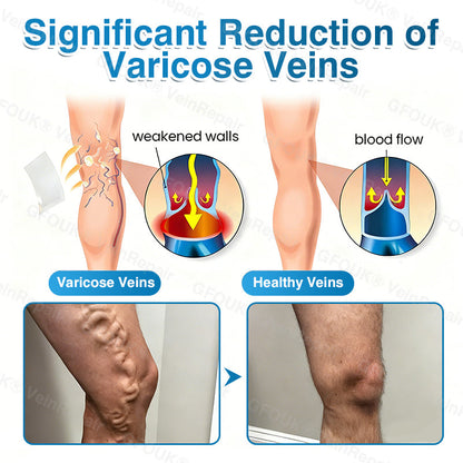 🇺🇸🏅🌱AIYNS Official Store -  VeinRepair Microneedle Patch Roll⚡Instant Relief, Long-Term Results