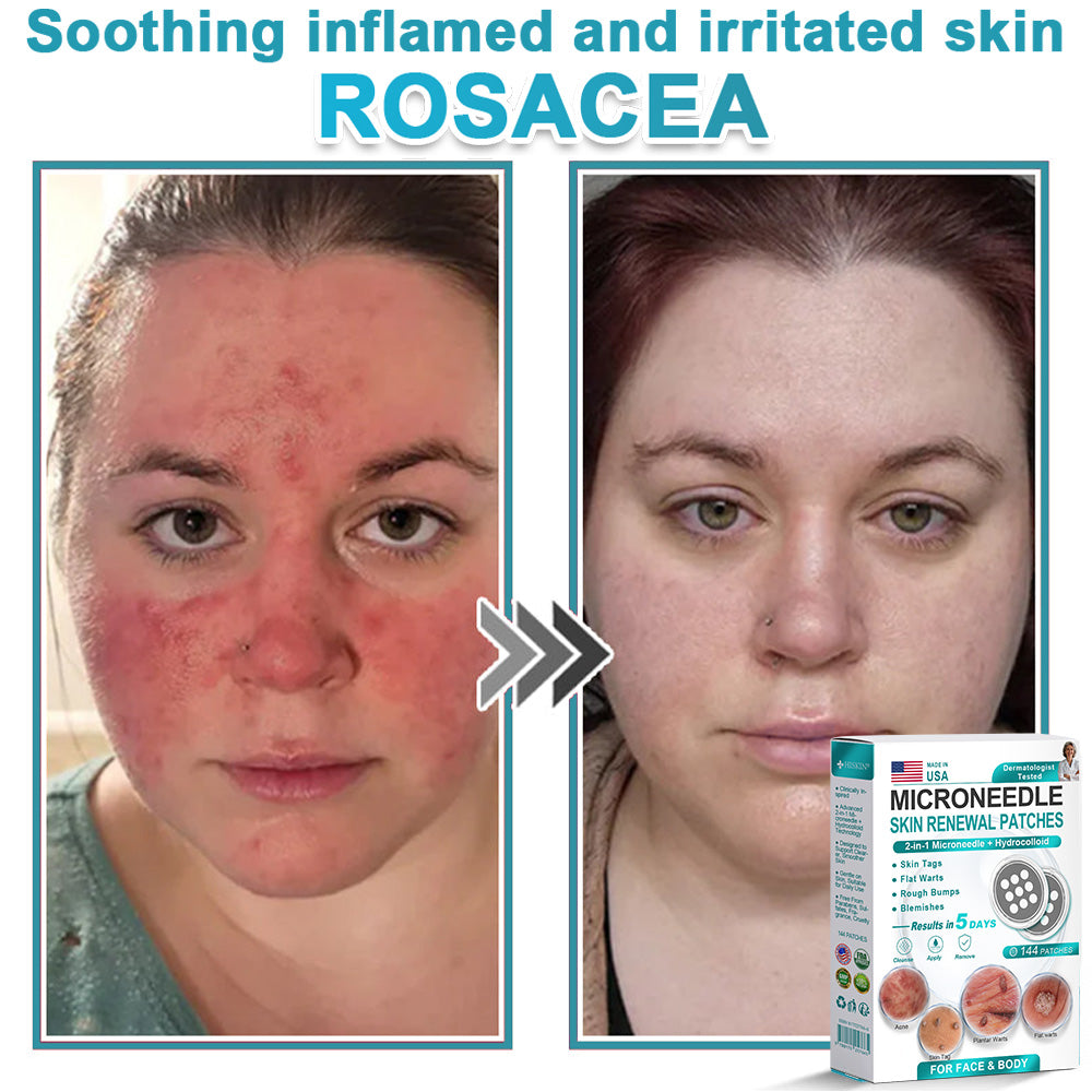 AIYNS Official Store -  2-in-1 Microneedle & Hydrocolloid Patch👨‍⚕️ | Removes raised moles, acne, flat warts, and skin tags | Helps improve wrinkles, scars, and blemishes | Invisible patches for face and body