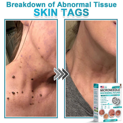 AIYNS Official Store -  2-in-1 Microneedle & Hydrocolloid Patch👨‍⚕️ | Removes raised moles, acne, flat warts, and skin tags | Helps improve wrinkles, scars, and blemishes | Invisible patches for face and body