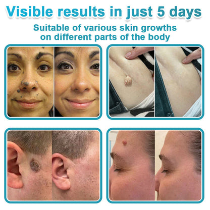 AIYNS Official Store -  2-in-1 Microneedle & Hydrocolloid Patch👨‍⚕️ | Removes raised moles, acne, flat warts, and skin tags | Helps improve wrinkles, scars, and blemishes | Invisible patches for face and body