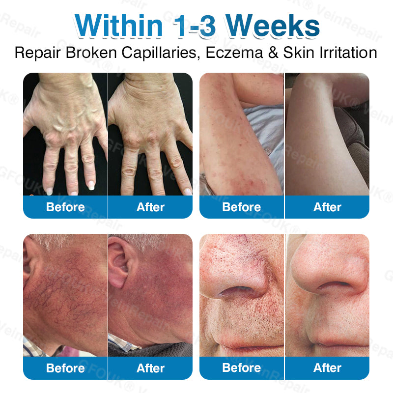 🇺🇸🏅🌱AIYNS Official Store -  VeinRepair Microneedle Patch Roll⚡Instant Relief, Long-Term Results