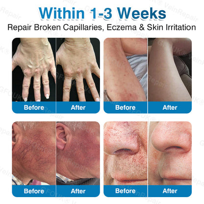 🇺🇸🏅🌱AIYNS Official Store -  VeinRepair Microneedle Patch Roll⚡Instant Relief, Long-Term Results