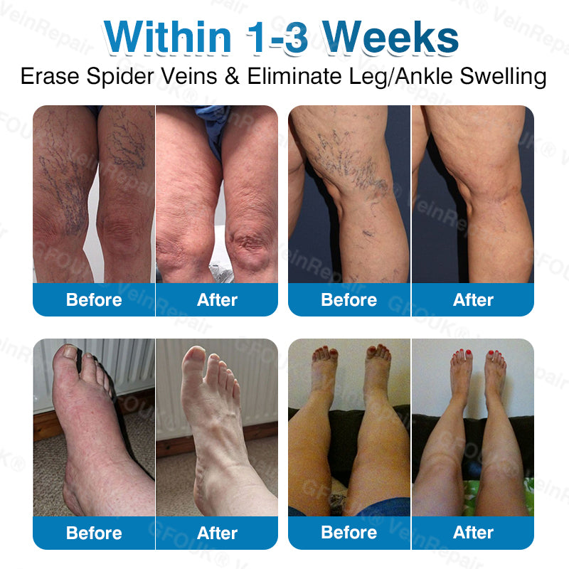 🇺🇸🏅🌱AIYNS Official Store -  VeinRepair Microneedle Patch Roll⚡Instant Relief, Long-Term Results