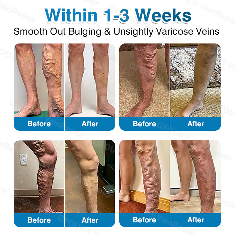 🇺🇸🏅🌱AIYNS Official Store -  VeinRepair Microneedle Patch Roll⚡Instant Relief, Long-Term Results