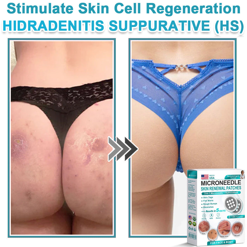 AIYNS Official Store -  2-in-1 Microneedle & Hydrocolloid Patch👨‍⚕️ | Removes raised moles, acne, flat warts, and skin tags | Helps improve wrinkles, scars, and blemishes | Invisible patches for face and body