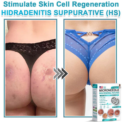 AIYNS Official Store -  2-in-1 Microneedle & Hydrocolloid Patch👨‍⚕️ | Removes raised moles, acne, flat warts, and skin tags | Helps improve wrinkles, scars, and blemishes | Invisible patches for face and body