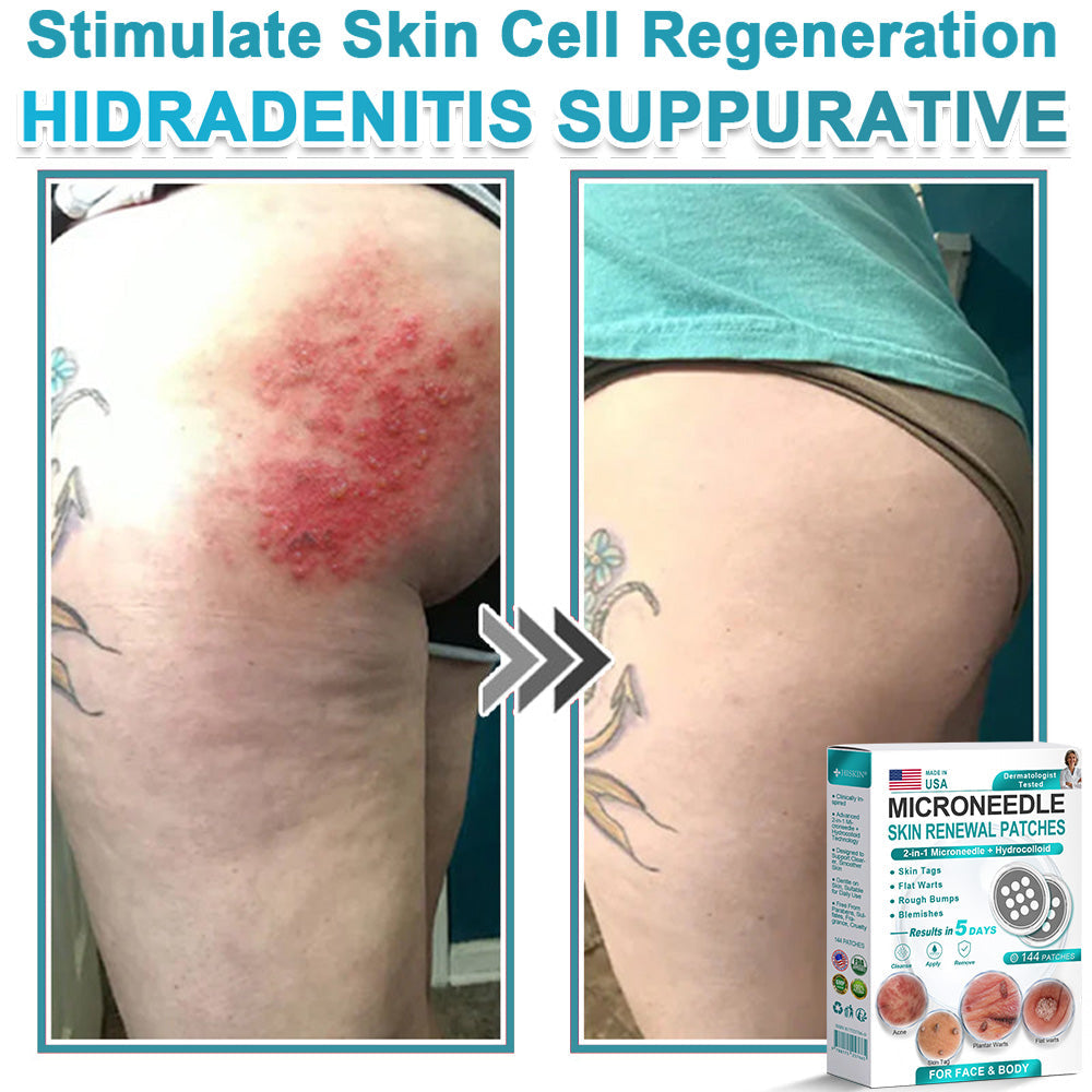 AIYNS Official Store -  2-in-1 Microneedle & Hydrocolloid Patch👨‍⚕️ | Removes raised moles, acne, flat warts, and skin tags | Helps improve wrinkles, scars, and blemishes | Invisible patches for face and body