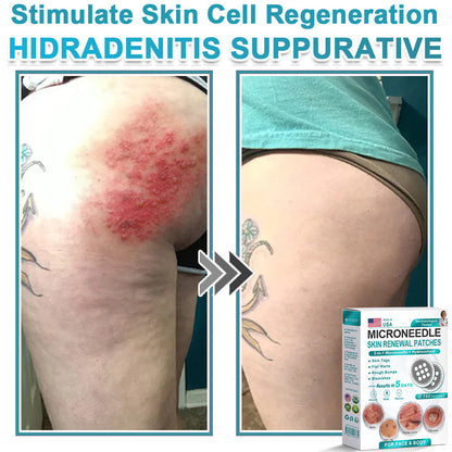AIYNS Official Store -  2-in-1 Microneedle & Hydrocolloid Patch👨‍⚕️ | Removes raised moles, acne, flat warts, and skin tags | Helps improve wrinkles, scars, and blemishes | Invisible patches for face and body