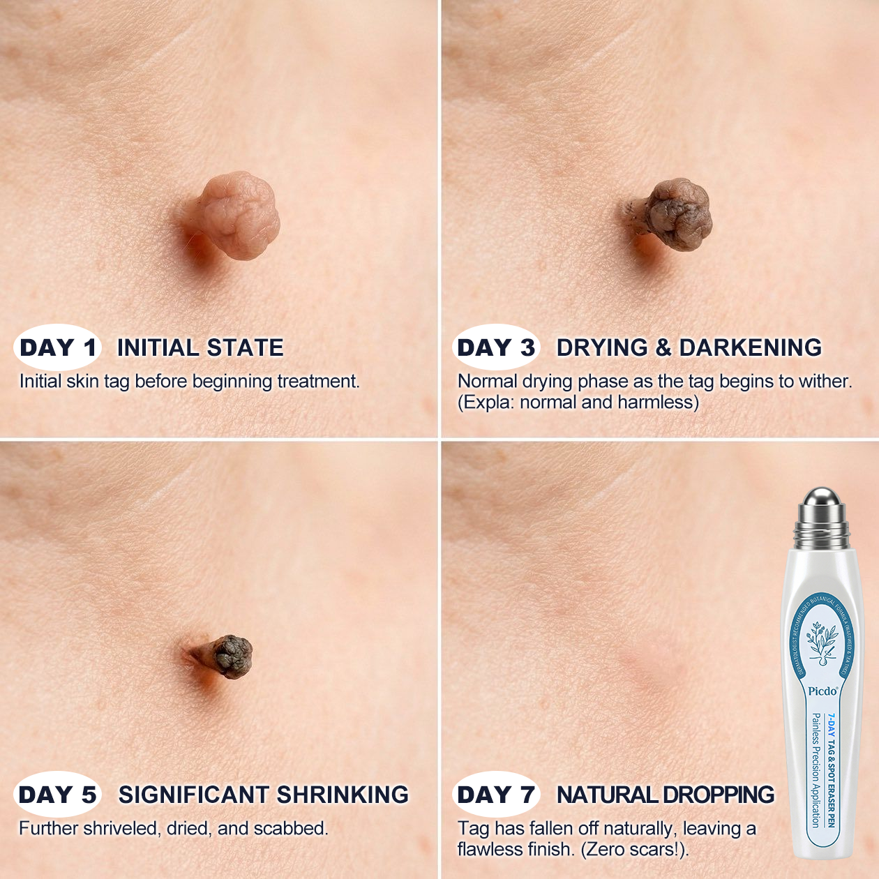 AIYNS Official Store - 7 𝐷𝑎𝑦 𝗧𝐚𝐠 & 𝗦𝗽𝐨𝐭 𝐄𝐫𝒂𝒔𝒆𝒓(Zero Pain, Zero 𝐒𝐜𝐚𝒓𝒔 Rollerball)💎