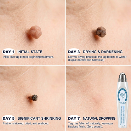 AIYNS Official Store - 7 𝐷𝑎𝑦 𝗧𝐚𝐠 & 𝗦𝗽𝐨𝐭 𝐄𝐫𝒂𝒔𝒆𝒓(Zero Pain, Zero 𝐒𝐜𝐚𝒓𝒔 Rollerball)💎
